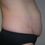 Abdominoplasty Before & After Patient #891