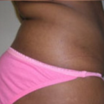 Abdominoplasty Before & After Patient #892