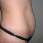 Abdominoplasty Before & After Patient #893