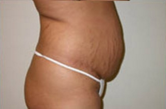 Abdominoplasty Before & After Patient #895