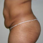Abdominoplasty Before & After Patient #897