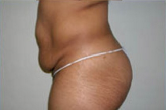 Abdominoplasty Before & After Patient #897