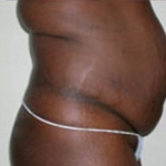 Abdominoplasty Before & After Patient #898