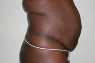 Abdominoplasty Before & After Patient #898