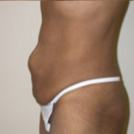 Abdominoplasty Before & After Patient #943