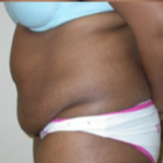 Abdominoplasty Before & After Patient #944