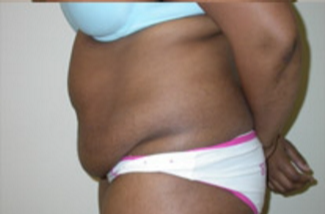 Abdominoplasty Before & After Patient #944