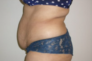Abdominoplasty Before & After Patient #945