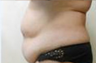 Abdominoplasty Before & After Patient #946