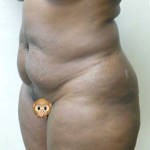 Abdominoplasty Before & After Patient #991