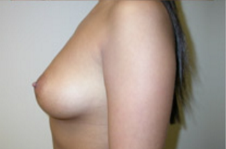 Breast Augmentation Before & After Patient #376