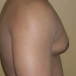 Liposuction Before & After Patient #1028