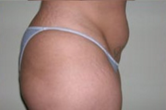 Liposuction Before & After Patient #1058