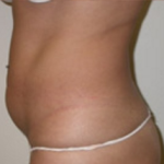 Liposuction Before & After Patient #1063