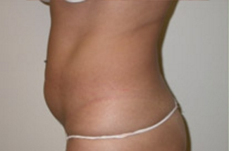 Liposuction Before & After Patient #1063