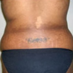 Liposuction Before & After Patient #1064
