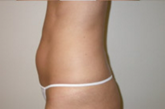 Liposuction Before & After Patient #1094