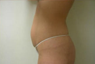Liposuction Before & After Patient #1095