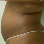Abdominoplasty Before & After Patient #779
