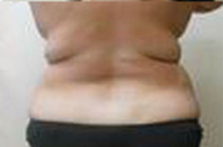 Abdominoplasty Before & After Patient #946