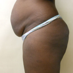 Abdominoplasty Before & After Patient #994