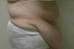 Abdominoplasty Before & After Patient #781