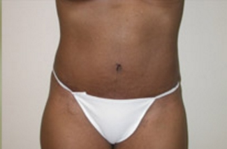 Abdominoplasty Before & After Patient #942