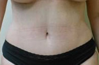 Abdominoplasty Before & After Patient #946