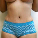 Abdominoplasty Before & After Patient #949