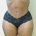 Abdominoplasty Before & After Patient #990