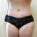 Abdominoplasty Before & After Patient #995