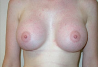 Breast Augmentation Before & After Patient #421