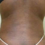 Liposuction Before & After Patient #1021