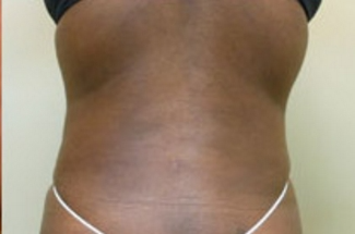 Liposuction Before & After Patient #1021