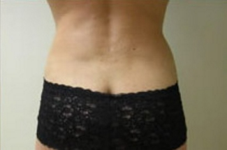 Liposuction Before & After Patient #1026
