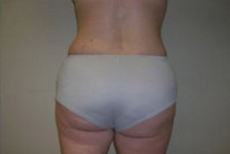 Liposuction Before & After Patient #1029