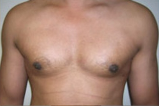 Liposuction Before & After Patient #1028