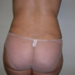 Liposuction Before & After Patient #1030