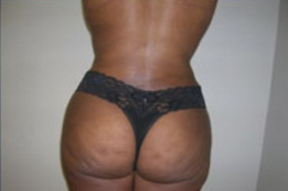 Liposuction Before & After Patient #1055