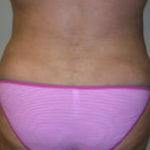 Liposuction Before & After Patient #1056