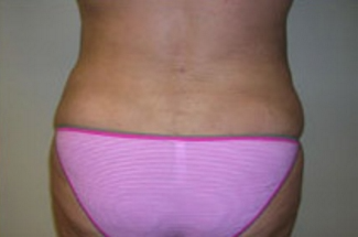 Liposuction Before & After Patient #1056