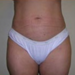 Liposuction Before & After Patient #1059