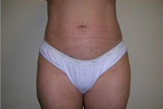 Liposuction Before & After Patient #1058