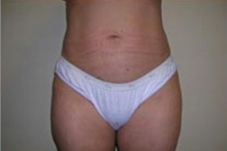 Liposuction Before & After Patient #1059