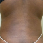 Liposuction Before & After Patient #1061