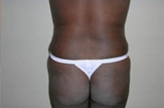 Liposuction Before & After Patient #1062