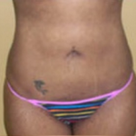 Liposuction Before & After Patient #1064