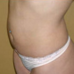 Liposuction Before & After Patient #1091
