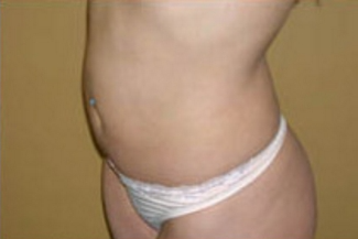 Liposuction Before & After Patient #1091