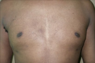 Liposuction Before & After Patient #1093